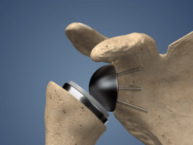 Shoulder Prosthesis