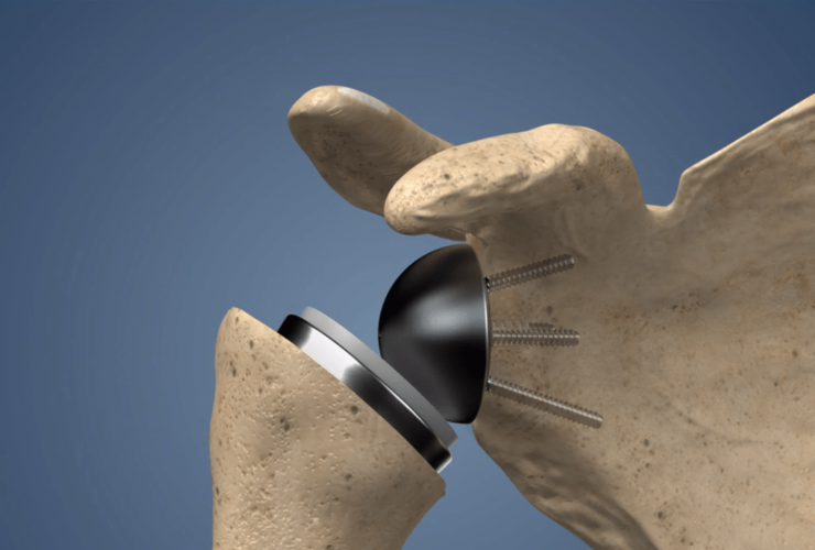 Shoulder Prosthesis