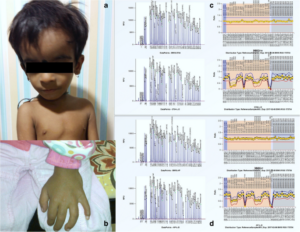 Russell-Silver Syndrome