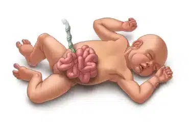 Gastroshiza